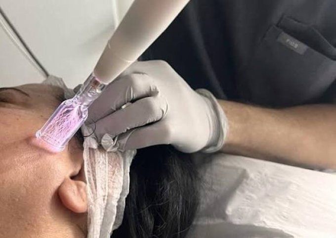 plamsa arc fusion 1h